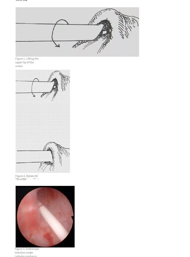 Rigid Ureteroscopy Techniques: A Practical Guide for Junior Surgeons (And Why Your Scope Choice Matters)