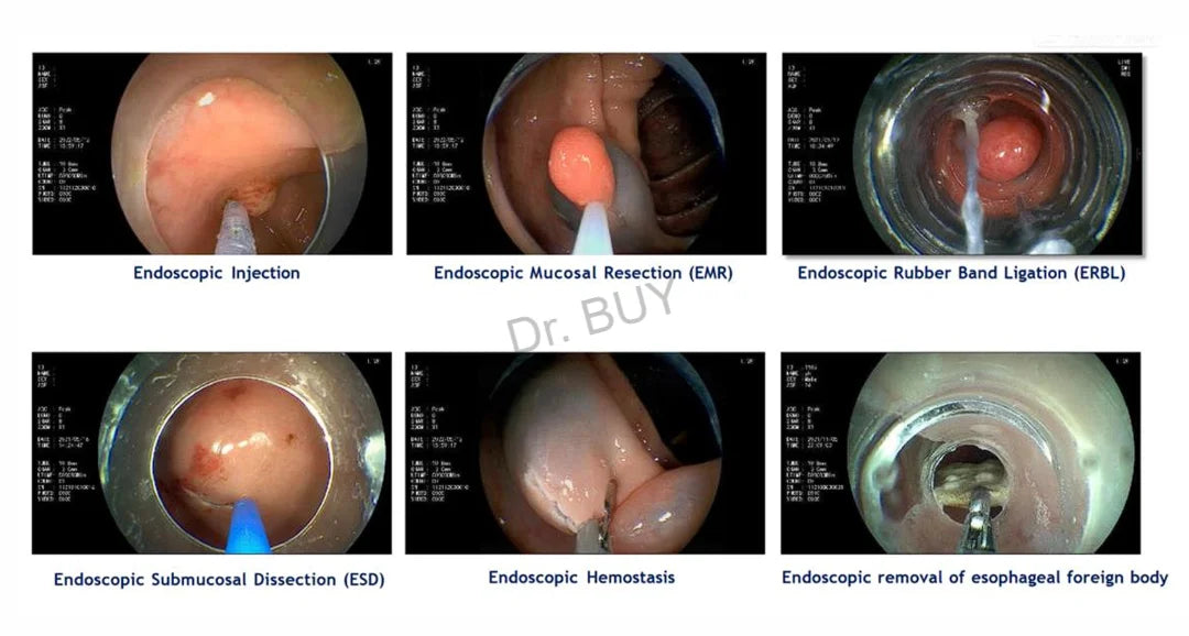 Disposable GI Endoscopy System | Single-Use Flexible Gastroscope & Colonoscope